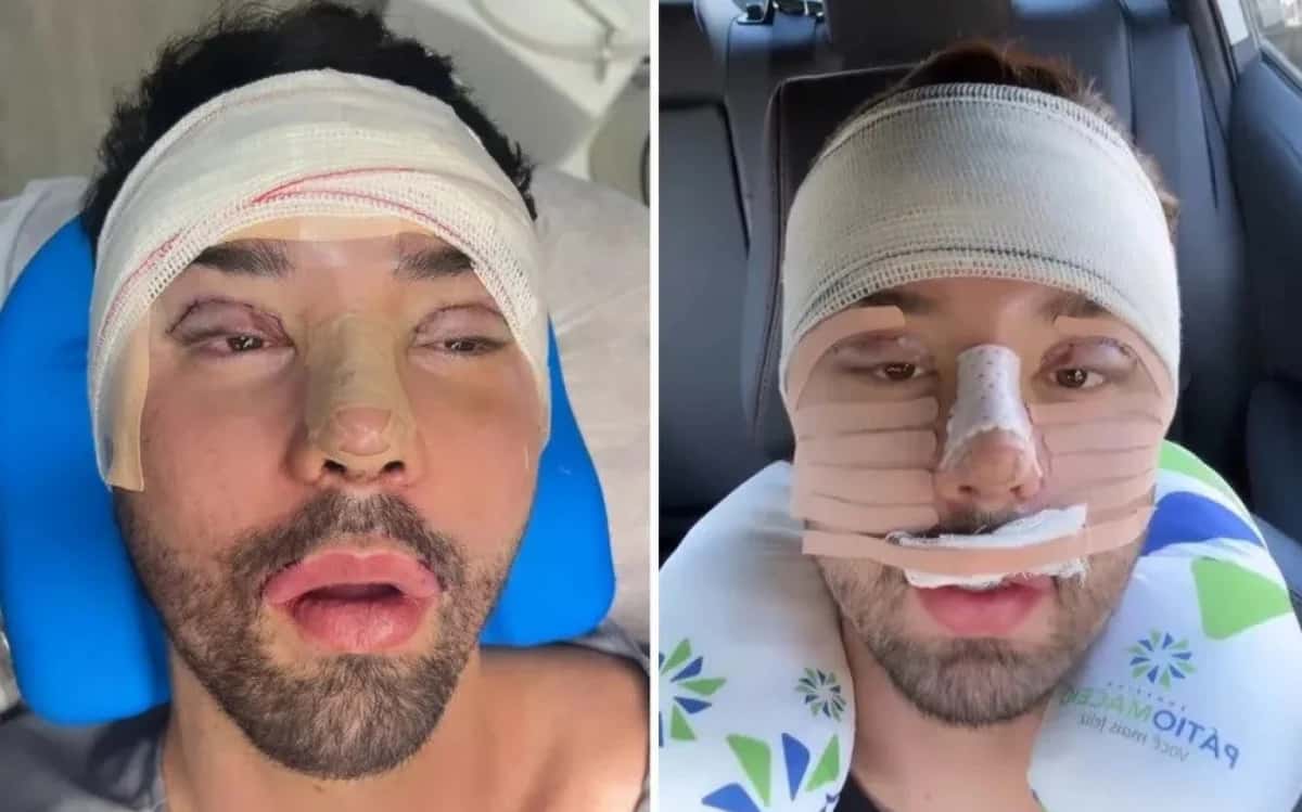 Feio? Rico Melquiades passa por cirurgia no rosto