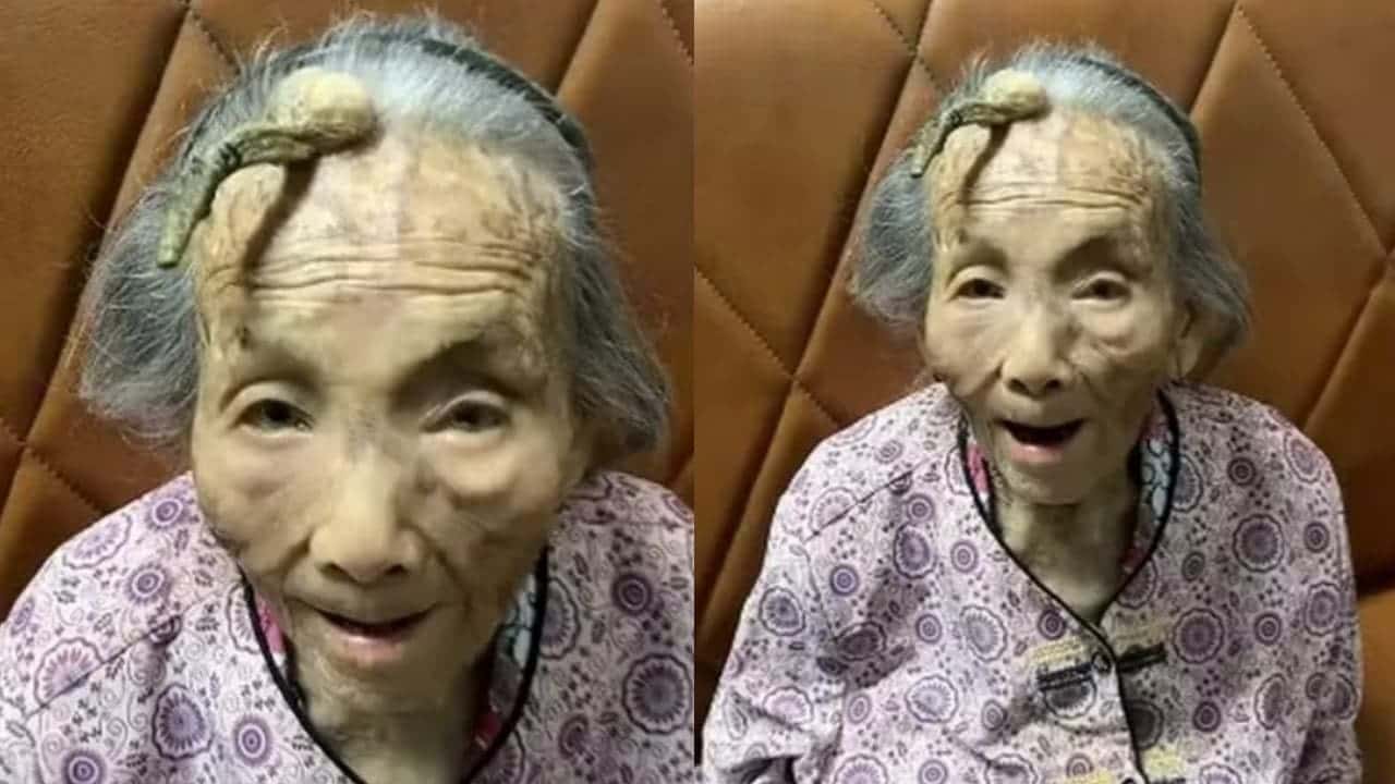 Idosa de 107 anos causa espanto após aparecer com chifre na testa