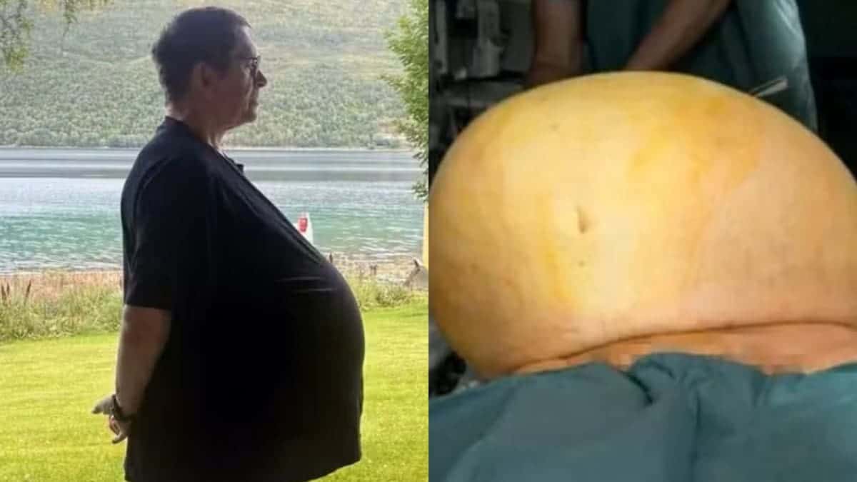 Homem diagnosticado com ‘obesidade’ descobre tumor de 27 quilos