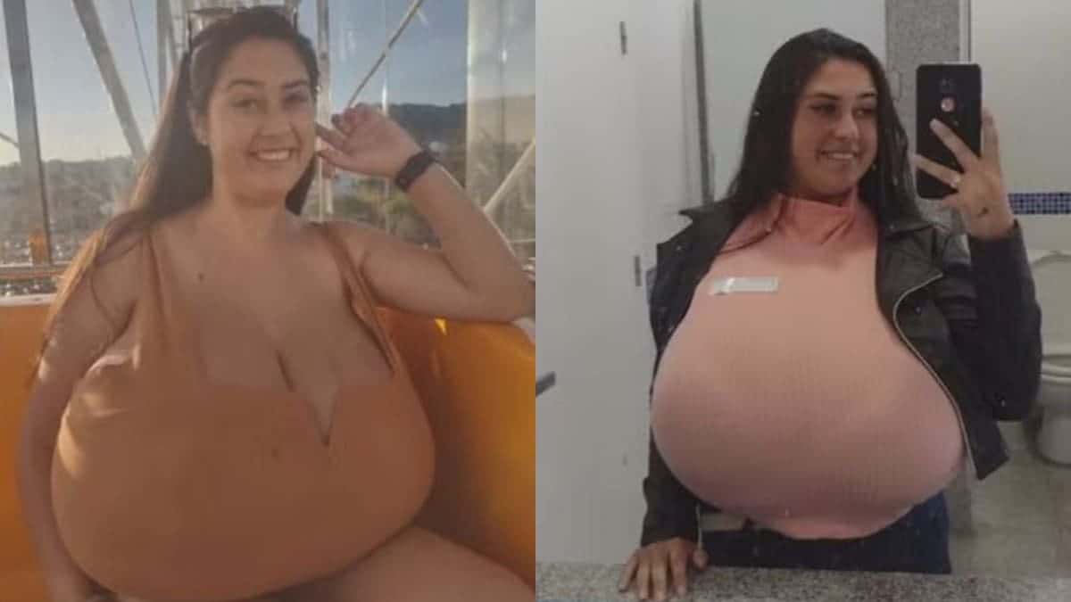 Jovem retira 10 kg de mama após doença com causa misteriosa