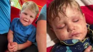 Criança de 2 anos leva mais de 150 picadas de vespas e é internado na UTI
