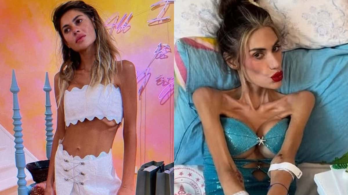 Influencer turca morre ao chegar aos 22 kg