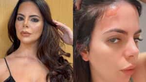 Ex-participante de reality sofre queimaduras após explosão de panela de pressão
