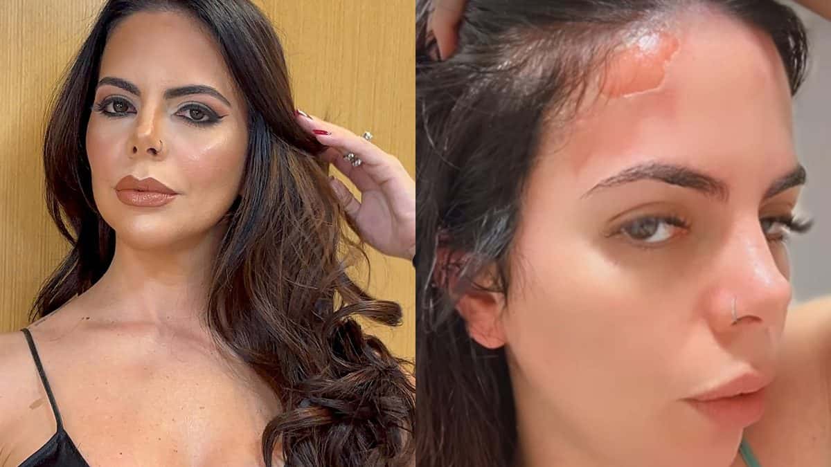 Ex-participante de reality sofre queimaduras após explosão de panela de pressão