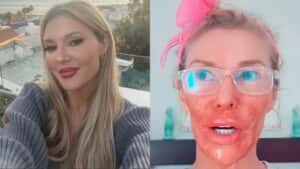 Ex-modelo tem rosto ‘derretido’ ao tentar matar parasita no rosto