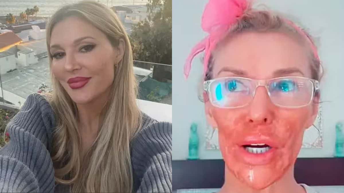 Ex-modelo tem rosto ‘derretido’ ao tentar matar parasita no rosto