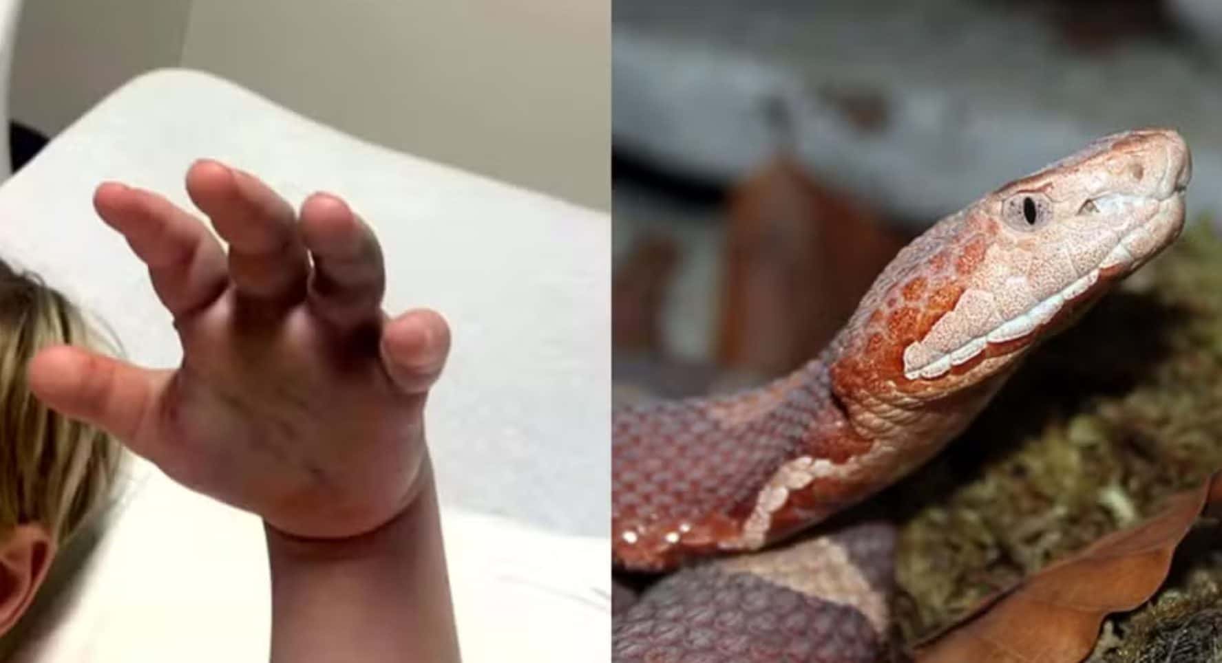 Criança é picada por cobra e creche ignora por achar que era uma farpa