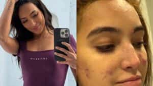 Vanessa Lopes fala sobre pressão estética em tratamento contra acne
