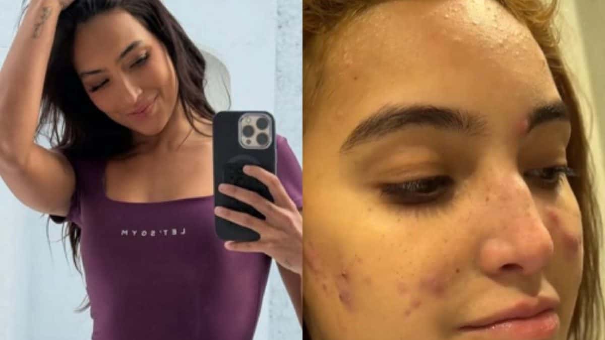 Vanessa Lopes fala sobre pressão estética em tratamento contra acne