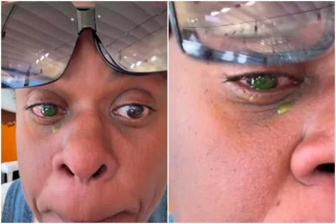 Cacau Protásio mostra desespero após reação alérgica: “Sem abrir o olho”