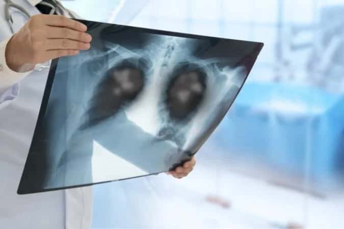 Inca anuncia estudo para implementar rastreamento de câncer de pulmão no SUS