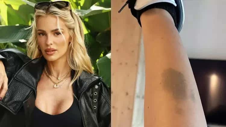 Yasmin Brunet exibe hematoma causado por lipedema e faz desabafo
