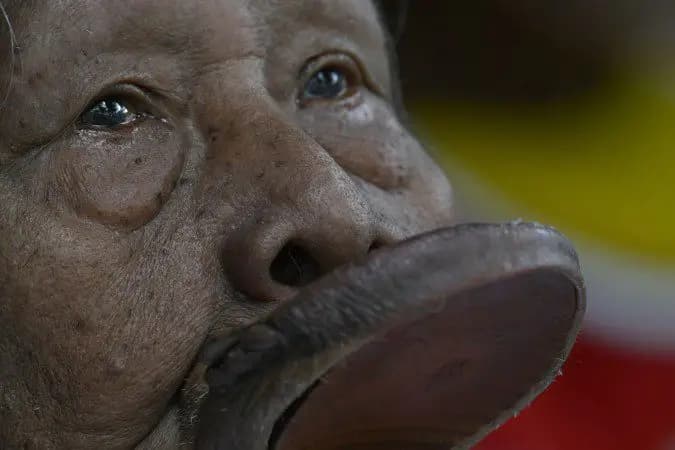 Cacique Raoni passa por cirurgia de desobstrução intestinal