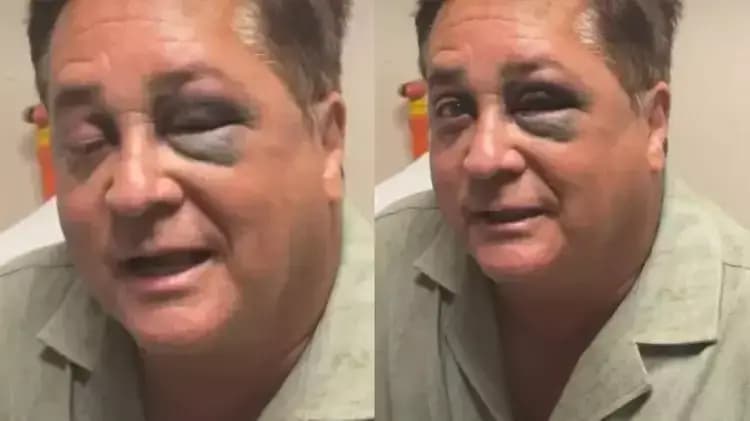Leonardo surge de olho roxo após acidente e esposa relata susto em passeio