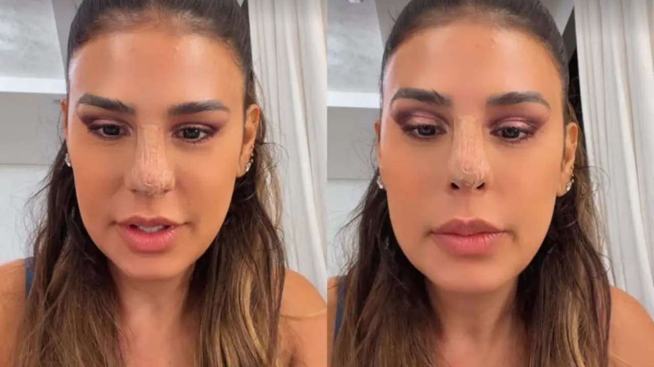 Simone Mendes fala sobre plástica no nariz: 'Levei um susto'