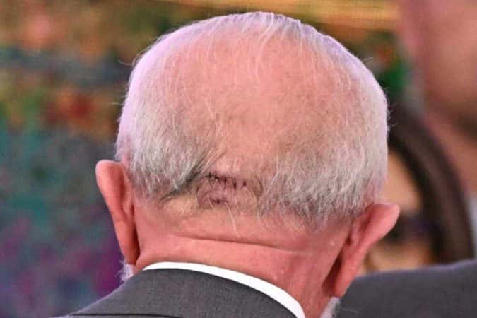 Tudo que se sabe sobre a cirurgia e a recuperação de Lula