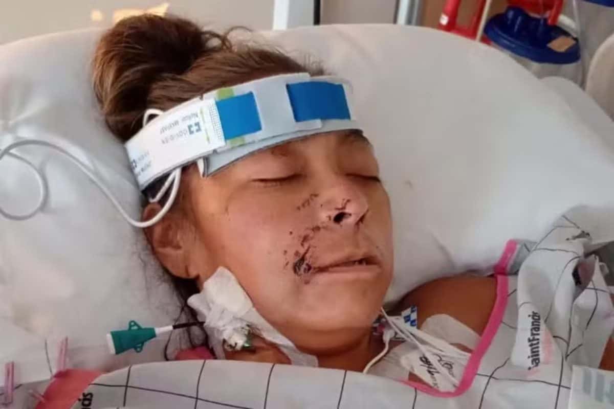 Mulher perde braços e pernas ao ser atacada por dois pitbulls