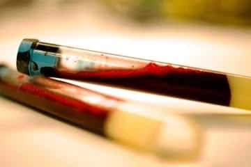 Detectado novo biomarcador do Parkinson