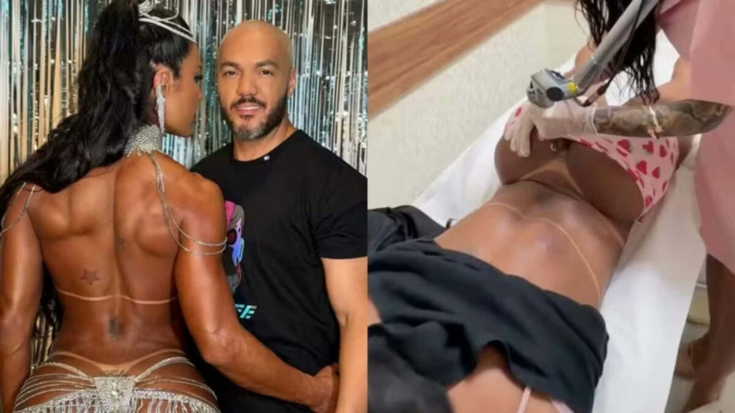 Gracyanne inicia retirada de tatuagem íntima dedicada para Belo