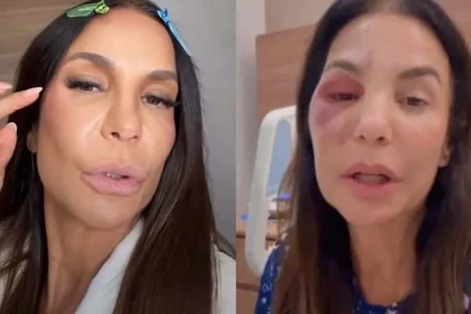 Ivete Sangalo revela implantação de duas peças de titânio no rosto; entenda