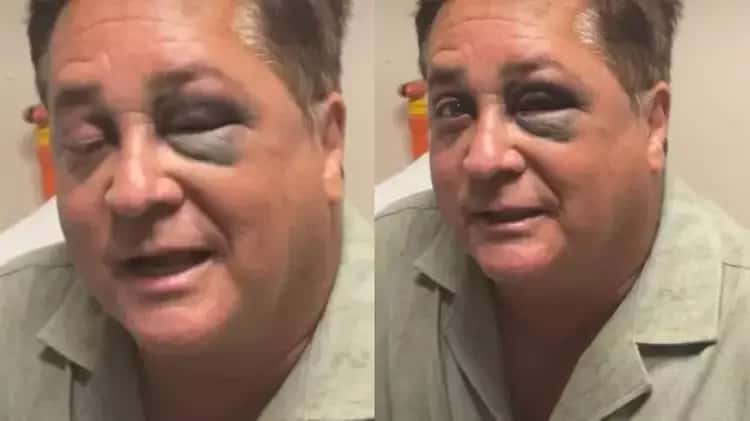 Leonardo surge de olho roxo após acidente e esposa relata susto em passeio