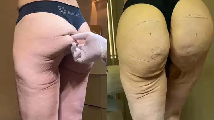 ‘Bumbum de Mounjaro’: médico exibe efeito de canetas emagrecedoras